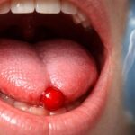 Ce que révèle une boule de sang sous la langue sur votre santé