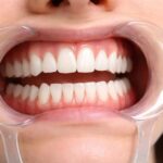 Utilisation de l&rsquo;écarteur dentaire pour accéder à la dentition et aux gencives