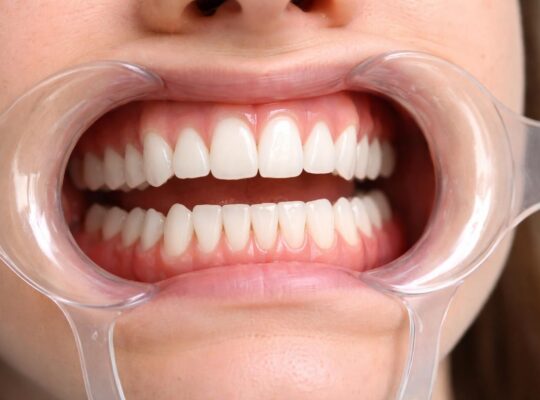 découvrez comment utiliser un écarteur dentaire pour faciliter l'accès à la dentition et aux gencives lors des soins bucco-dentaires, assurant une meilleure visibilité et un traitement efficace.