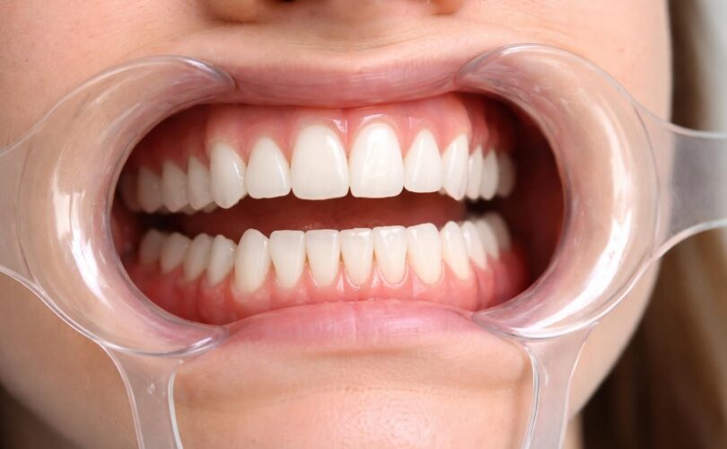 découvrez comment utiliser un écarteur dentaire pour faciliter l'accès à la dentition et aux gencives lors des soins bucco-dentaires, assurant une meilleure visibilité et un traitement efficace.