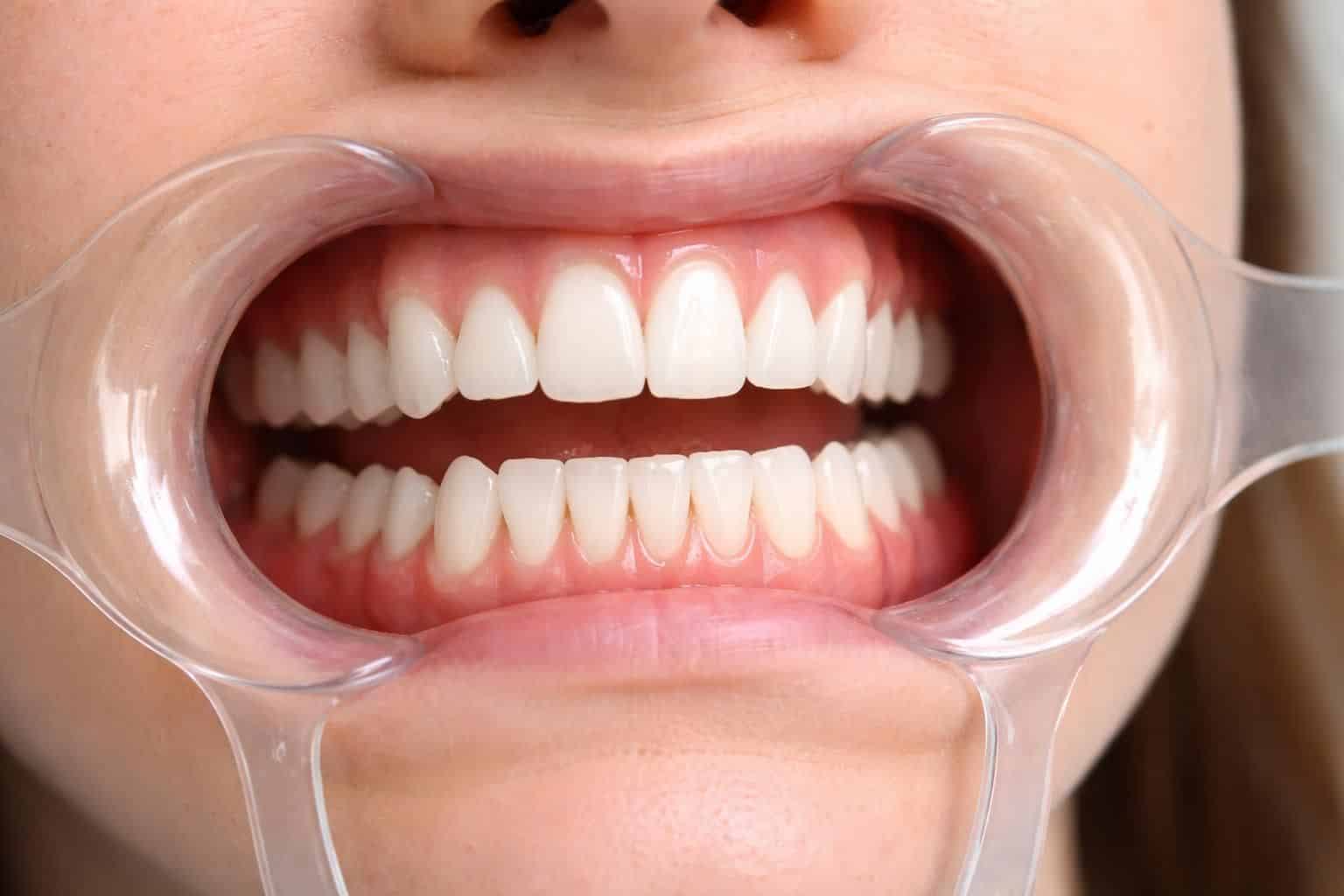 découvrez comment utiliser un écarteur dentaire pour faciliter l'accès à la dentition et aux gencives lors des soins bucco-dentaires, assurant une meilleure visibilité et un traitement efficace.