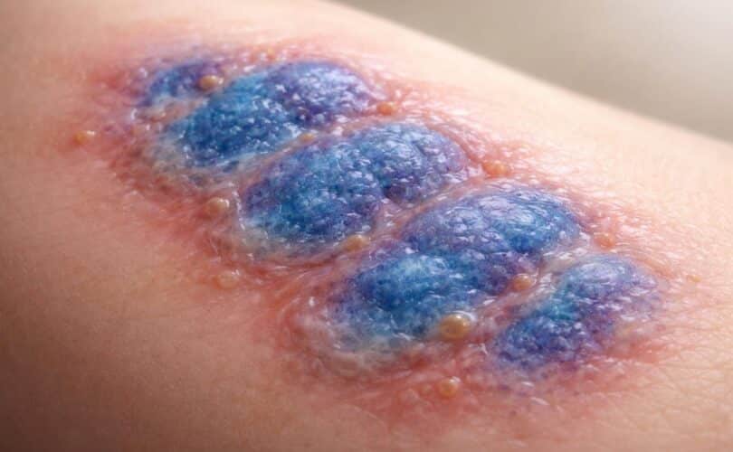 découvrez la vérité sur la maladie du blue waffle, un phénomène viral sur internet souvent entouré de mythes et de désinformations.